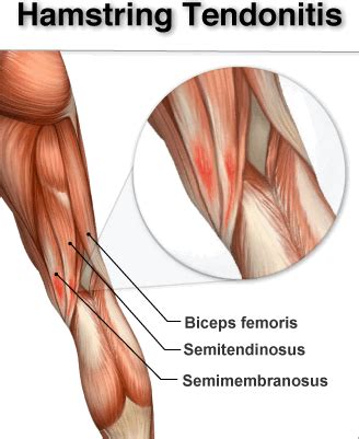 Hamstring Muscle – Function and Importance | Chiropractor Bloomington IL| Shepard Pain ...