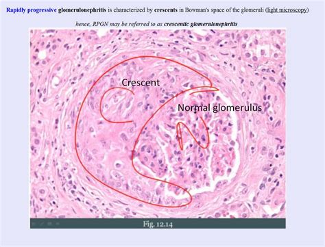 Is rapidly progressive glomerulonephritis = crescentic glomerulonephritis (at least for the ...