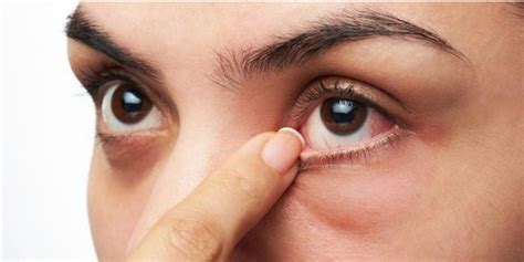 Trachoma: Causes, symptoms and treatment | Vinmec