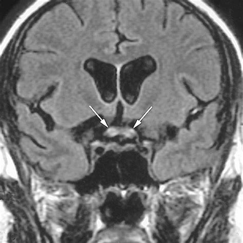 Optic Chiasm, Optic Nerve, and Retinal Involvement Secondary to Varicella-zoster Virus | Neuro ...