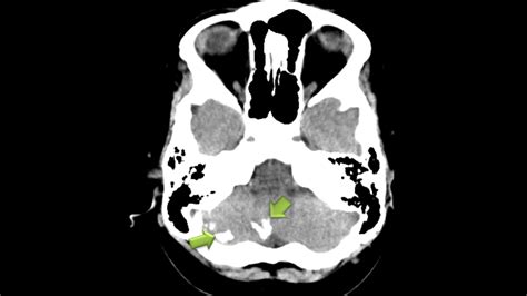 Confetti Skin Lesions Tuberous Sclerosis