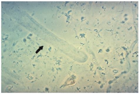 Urinalysis - Microscopic (Renal) Flashcards | Memorang | Medical laboratory technician, Medical ...