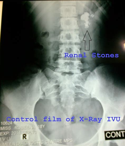 Types of Kidney Stones « General Surgical Operations