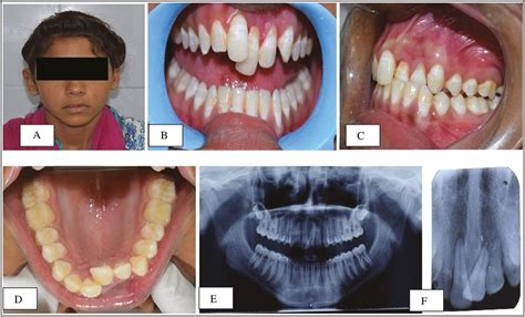 Successful Treatment of Laterally Luxated Teeth with Traumat ...