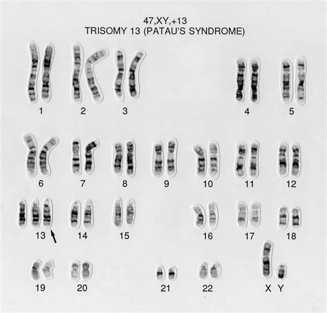 Human Karyotype Of Patau Syndrome Autosomal Abnormalities Trisomy | The ...