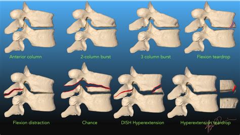 Spinal fractures- Classified by mechanism | UW Emergency Radiology