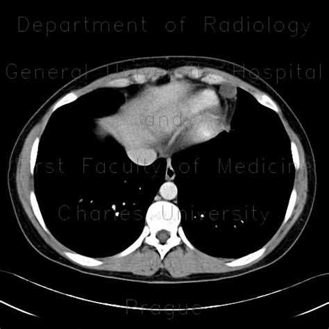 Radiology case: Pericardial cyst