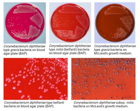 Corynebacterium diphtheriae (Klebs-Löffler bacillus)- An Overview