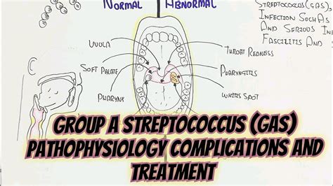 Strep Throat(Streptococcus A Group) GAS Pathophysiology Complications - YouTube