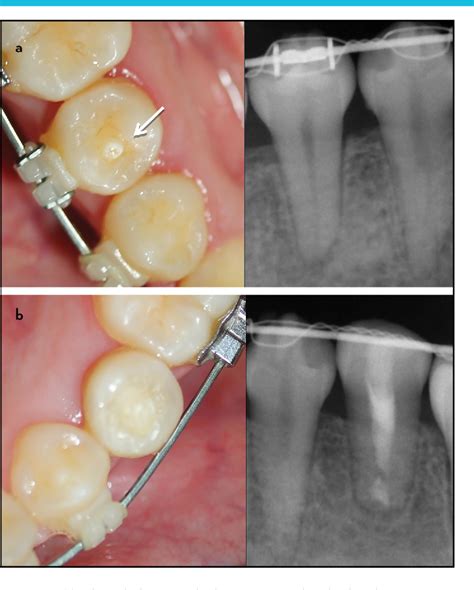 Figure 4 from Prevalence of Premolars with Dens Evaginatus in a Taiwanese and Spanish Population ...