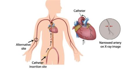 Cardiac Catheterization: Causes, Uses, Benefits, Diagnosis, Preparation, Treatment, Results & Risks