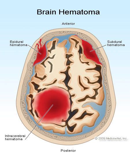 Epidural, subdural and intracerebral hematoma | Brain hemorrhage, Epidural hematoma, Brain injury