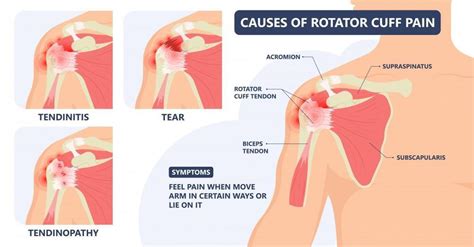 Rotator Cuff Injury Including Rotator Cuff Tear, Rotator Cuff Bursitis ...