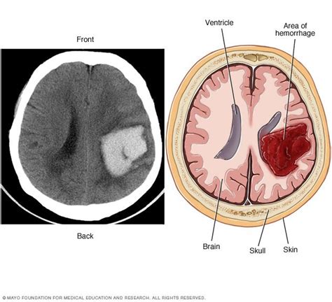 Brain AVM (arteriovenous malformation) Disease Reference Guide - Drugs.com