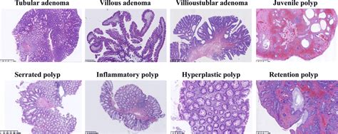 Different types of colonic polyps with hematoxylin-eosin staining | Download Scientific Diagram