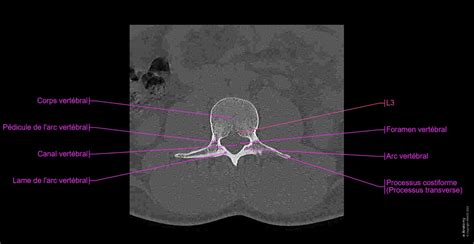 Rachis lombaire TDM : anatomie normale | e-Anatomy