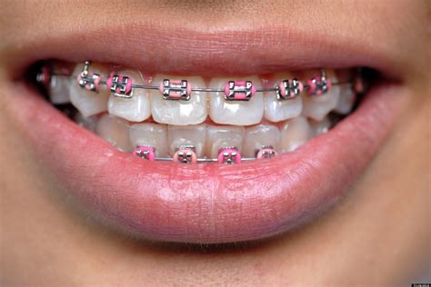 Asian Teens Wearing Fake Braces As Status Symbol: Report