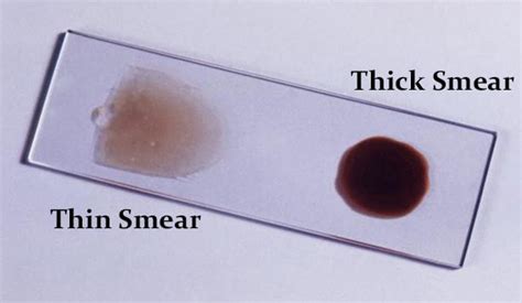 Differences Between Thick Blood Smear and Thin Blood Smear - Laboratory ...