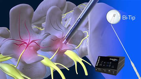 Endoscopic Facet Denervation Animation - YouTube