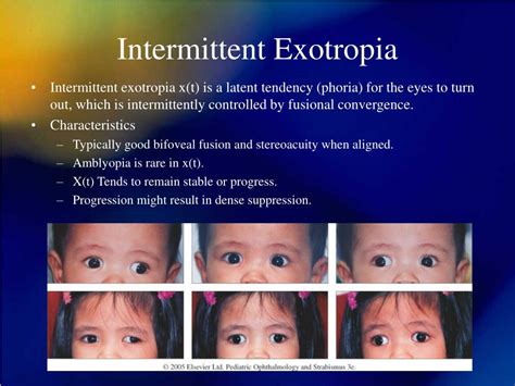 PPT - Surgical Outcomes in Intermittent Exotropia PowerPoint Presentation - ID:3379501