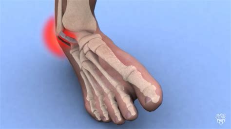 Ankle Sprain/Strain - Carolina Regional Orthopedics