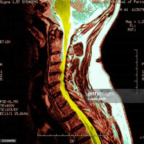 23 Cervical Spondylosis Stock Photos, High-Res Pictures, and Images ...