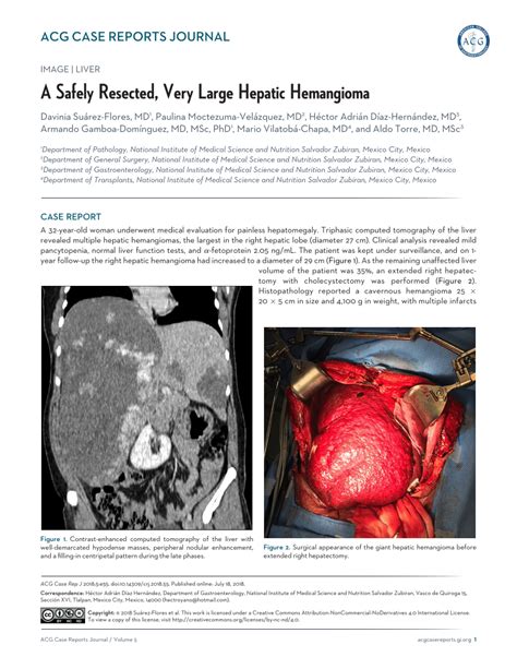 (PDF) A Safely Resected, Very Large Hepatic Hemangioma