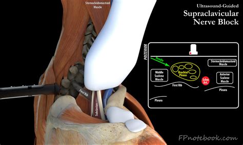 Supraclavicular Nerve Block