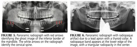 panorex-fig-5-6 - Decisions in Dentistry