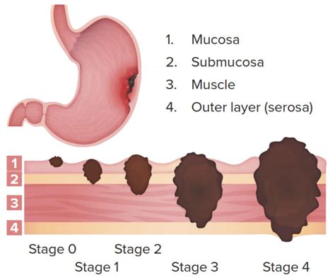 Gastric Cancer | Concise Medical Knowledge