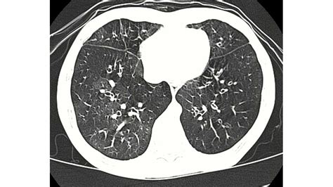 Popcorn Lung: Symptoms, Causes, Treatment, Prevention