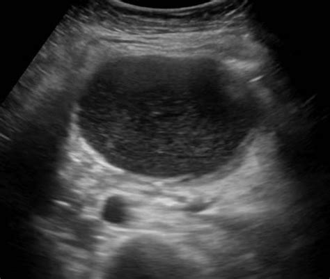 Abdomen and retroperitoneum | 1.3 Pancreas : Case 1.3.6 Pancreatic pseudocysts | Ultrasound Cases