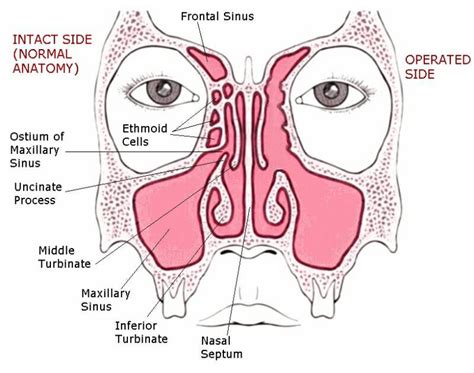 ENDOSCOPIC SINUS SURGERY