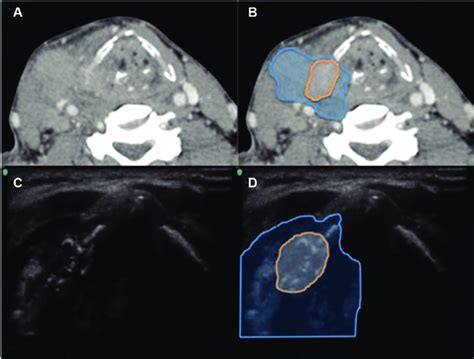 Hypopharynx-larynx, patient 16. (A) Axial computed tomography (CT). (B)... | Download Scientific ...