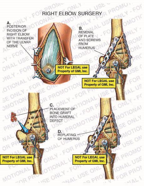 95132ccb Right Elbow Surgery - Medical Visions