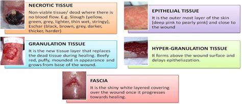 Different tissue types present in chronic wounds | Download Scientific Diagram