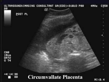 Ultrasound of Circumvallate Placenta | Ultrasound, Placenta