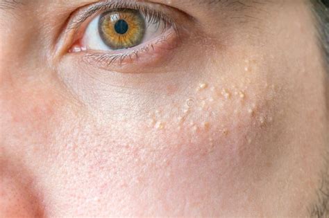 Milia (Milium) - Pimples Around Eye on Skin Stock Photo - Image of ...