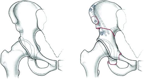 FAI—Acetabular Retroversion | Musculoskeletal Key