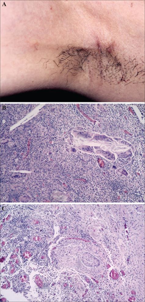 Axillary Web Syndrome