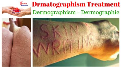 Drmatographism Treatment - Dermographism – Dermographic - YouTube