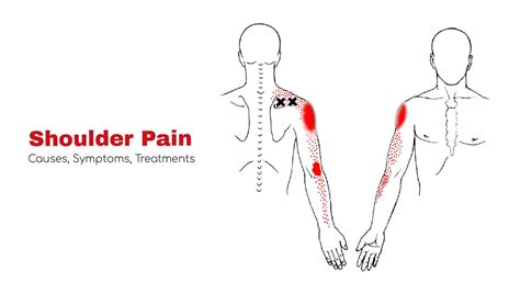 Shoulder Pain | Causes, symptoms, treatments ~ Statcardiologist