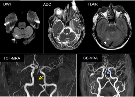 An uncommon pitfall in diagnosing basilar artery occlusion - European ...