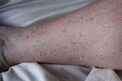 pneumonie Refrain Note itchy bumps on legs that look like mosquito ...