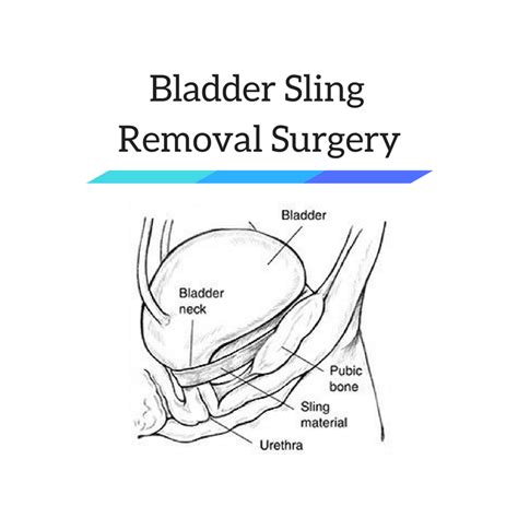 Bladder Sling Removal Surgery - Risk & Complications