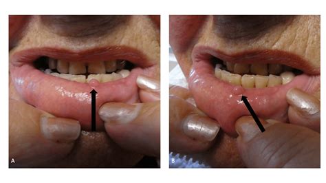 Cureus | Biting Fibroma of the Lower Lip: A Case Report and Literature ...