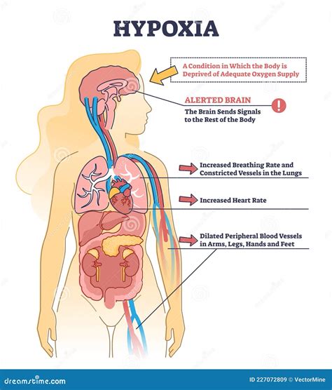 Hypoxia Condition As Lack of Oxygen in Brain Cells or Tissues Outline ...