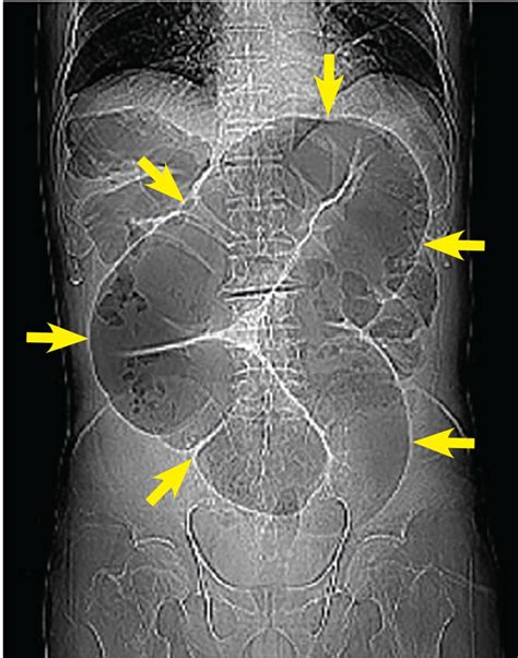 Sigmoid Volvulus Coffee Bean Sign