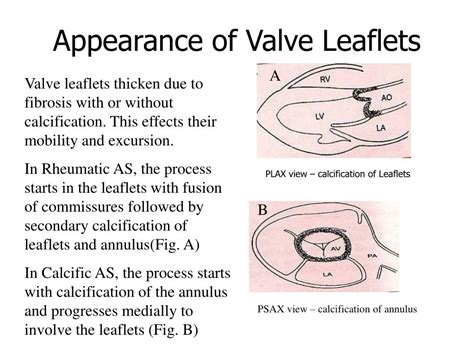 Aortic Valve Leaflets