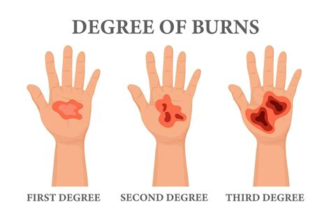 Burn stages. Burnt hands at various degrees. Skin burn symptoms. Medical healthcare concept ...